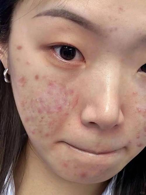 快手江苏女孩满脸痘痘