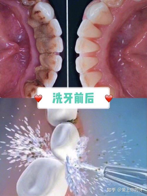 抖音上的洗牙的是什么