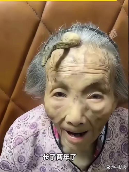 快手一个老人头上长蛆