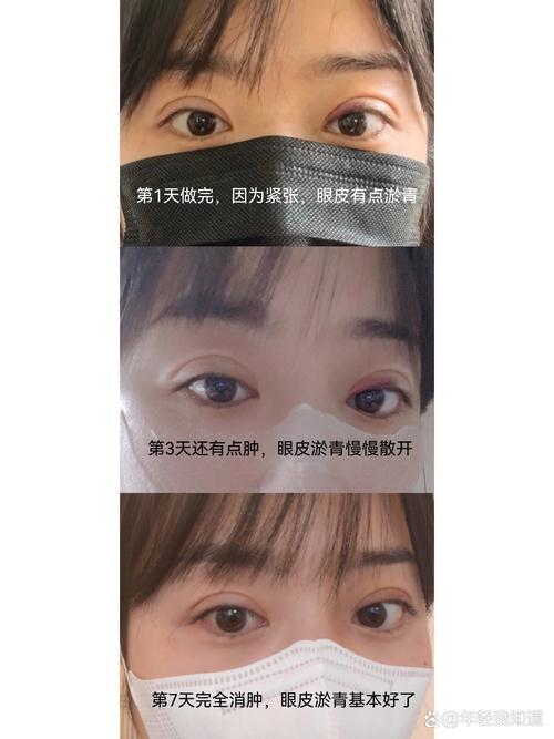 纳米双眼皮视频直播